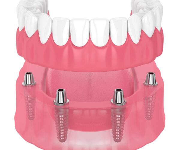 Protesi ancorate su impianti dentali