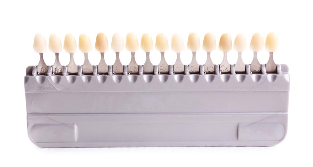 faccette in ceramica