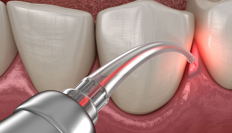 levigatura radicolare studio dentistico segrate