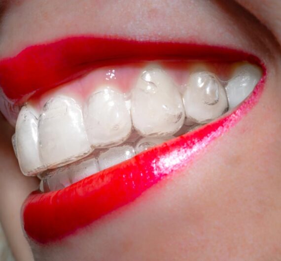 mascherina ortodontica invisibile