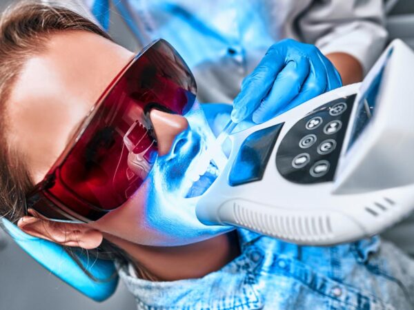 sbiancamento dei denti