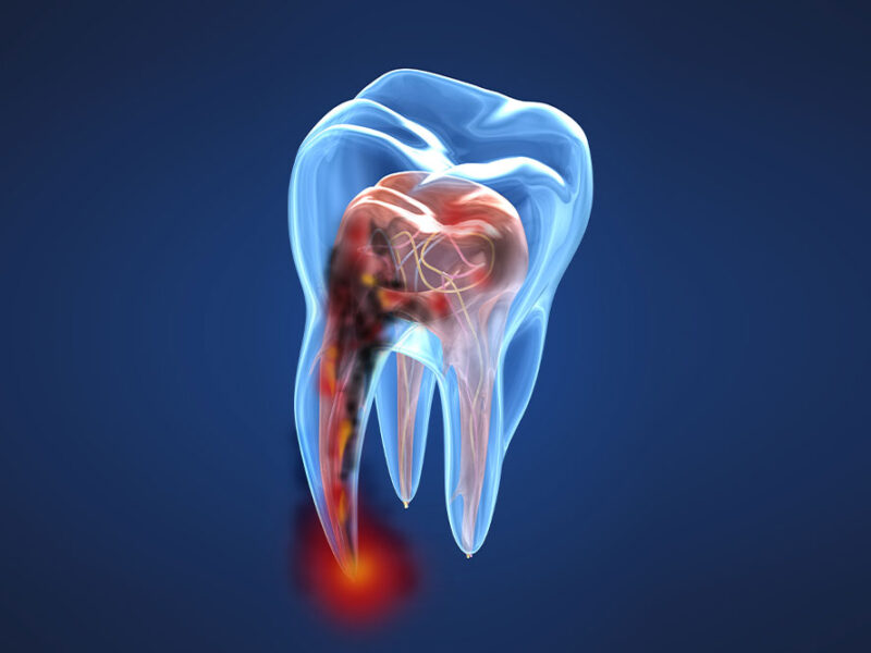 studio dentistico porro artusa esempio carie