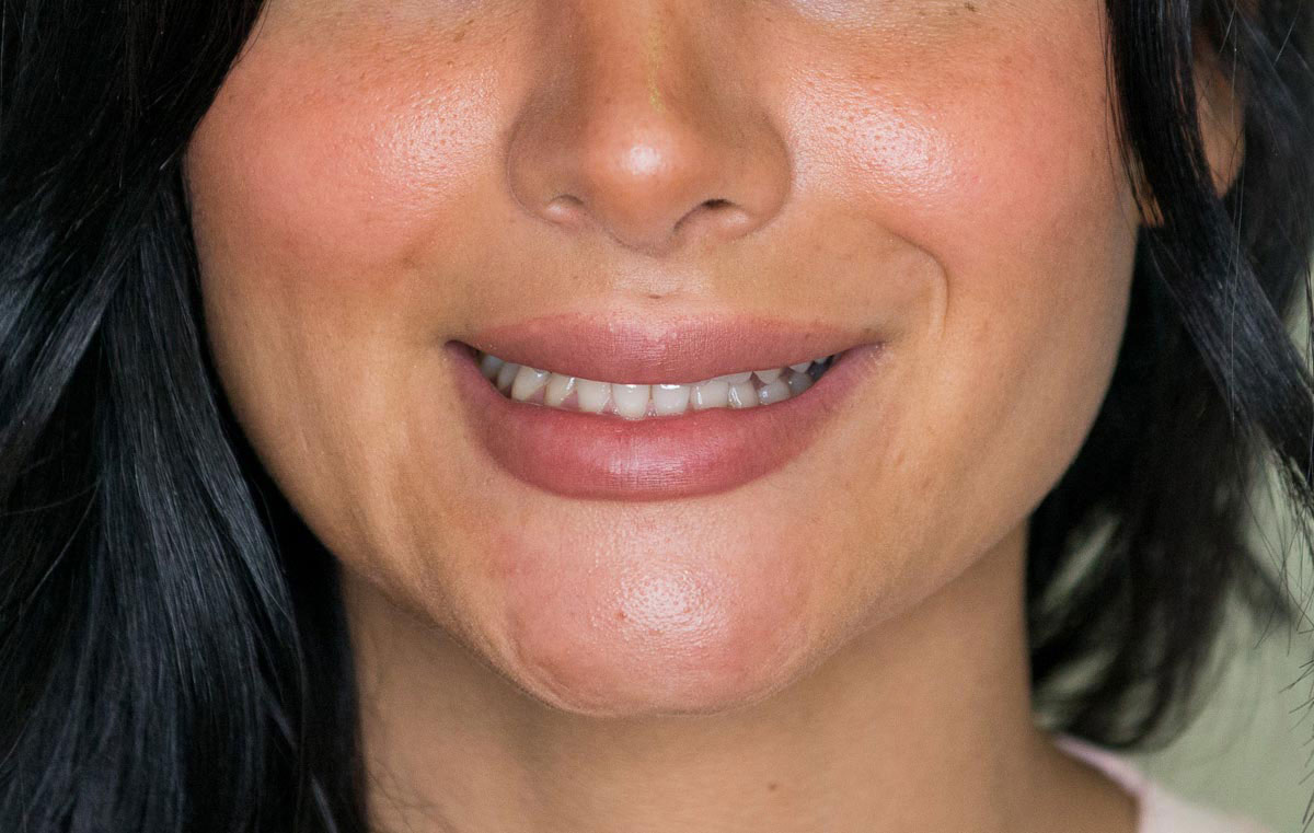 faccette dentali elite veneers prima prima