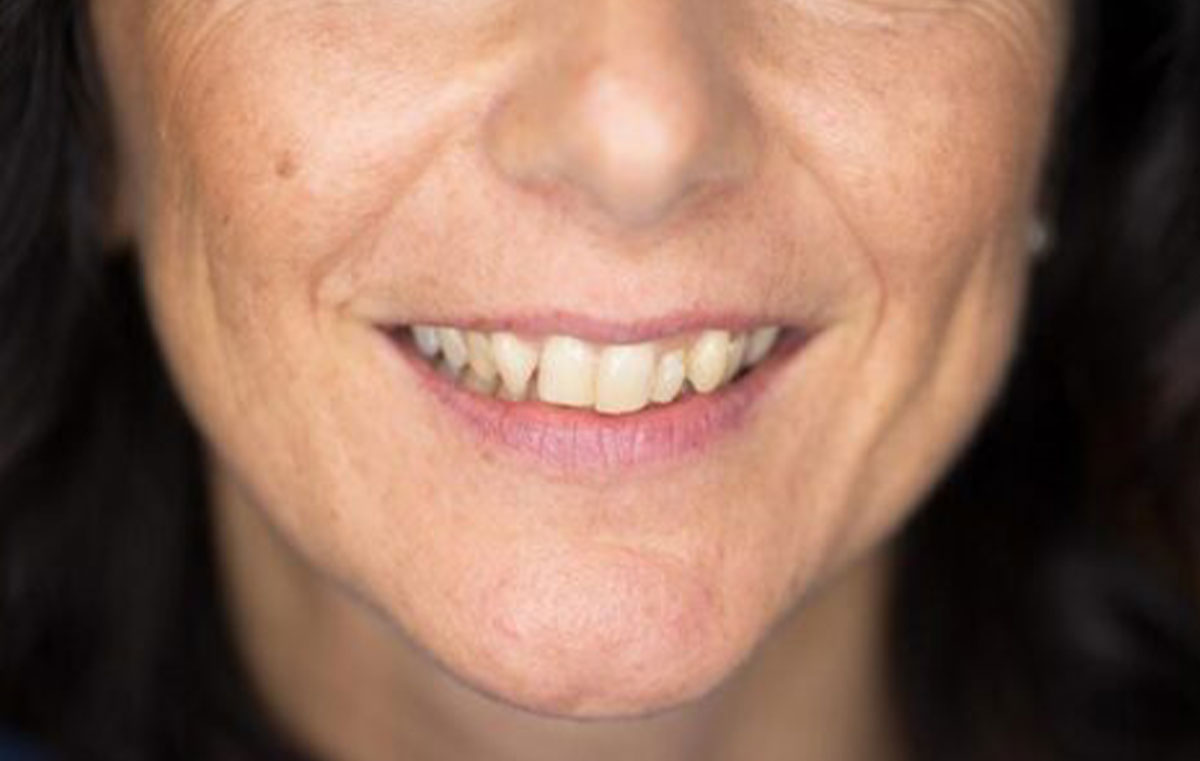 faccette dentali prima