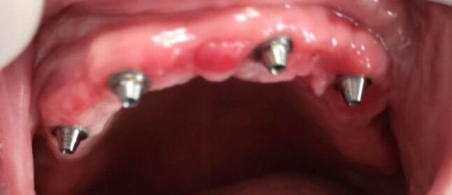 caso clinico 1 impianti fissi studio porro artusa caso clinico 1 impianti fissi studio porro artusa