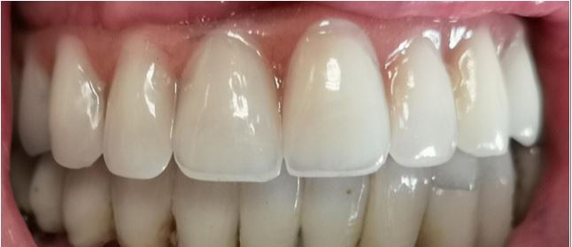 caso clinico 1 impianti fissi