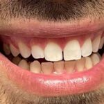 caso clinico 2 spazio fra denti