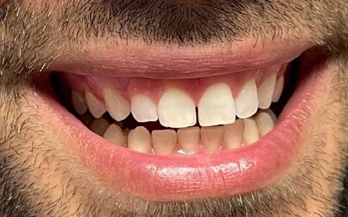 caso clinico 2 spazio fra denti