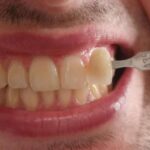 caso clinico 3 sbiancamento denti