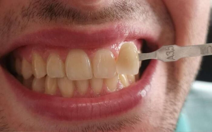 caso clinico 3 sbiancamento denti