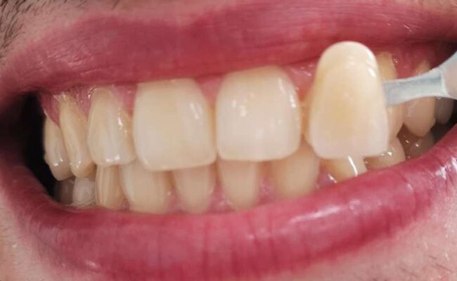 caso clinico 3 trattamento sbiancamento denti