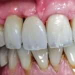 caso clinico 4 implantologia tradizionale