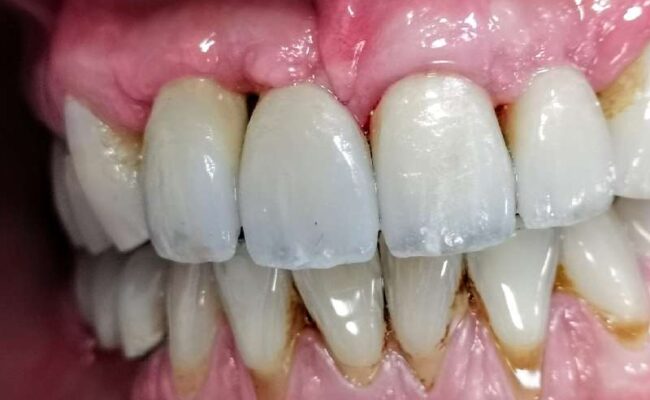 caso clinico 4 implantologia tradizionale