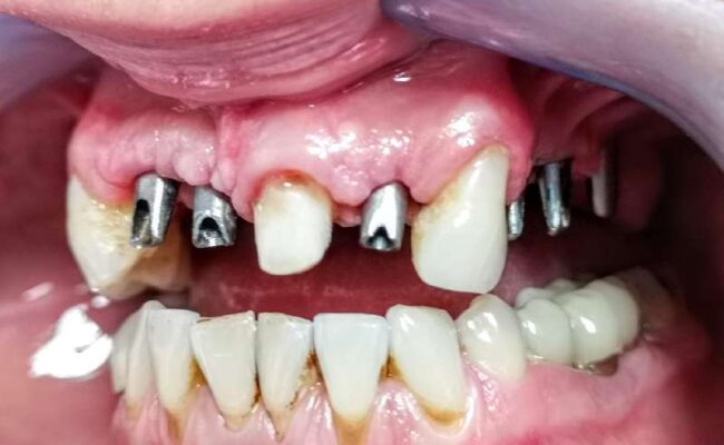 caso clinico 4 intervento implantologia tradizionale