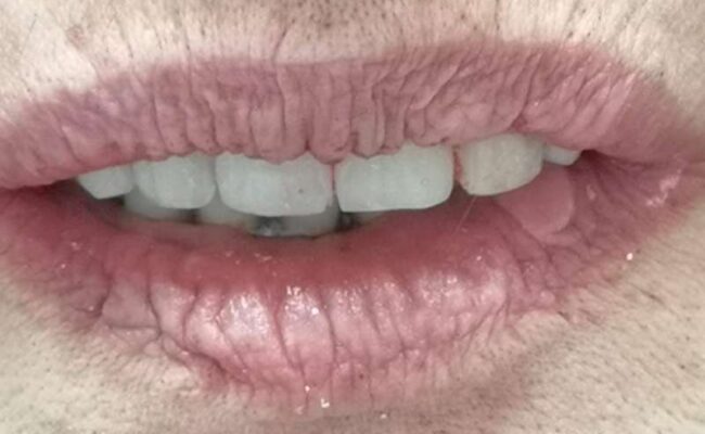 caso clinico 5 implantologia