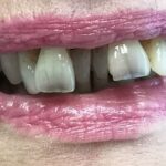 caso clinico 5 masticazione non corretta