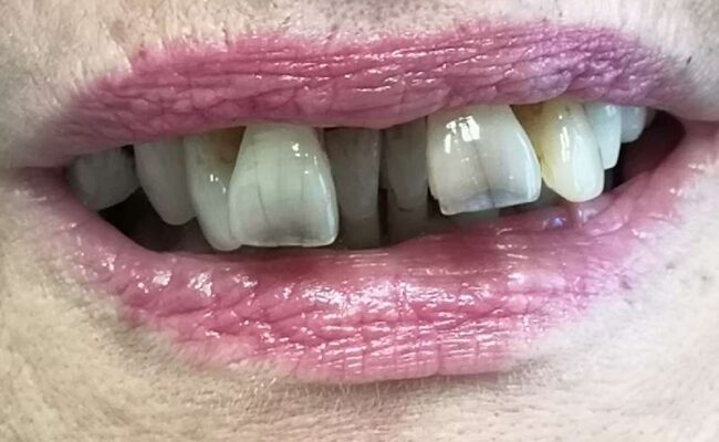 caso clinico 5 masticazione non corretta