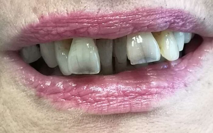 caso clinico 5 masticazione non corretta