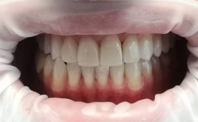 applicazione faccette dentali estetiche applicazione faccette dentali estetiche