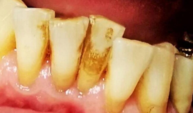 denti gialli sbiancamento denti gialli sbiancamento