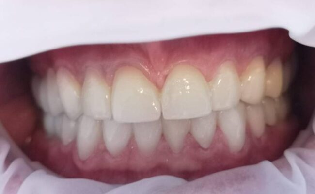 intervento riabilitazione bocca finale