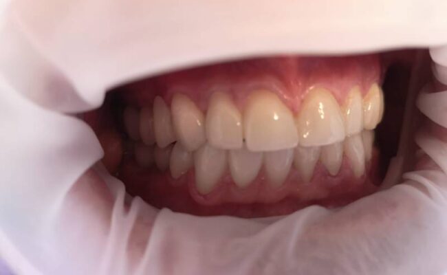 intervento riabilitazione bocca finale studio porro artusa