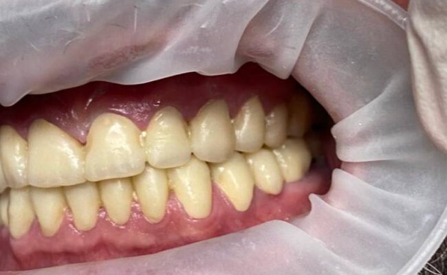 intervento riabilitazione bocca provvisoria