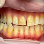 pulizia denti gialli studio porro artusa