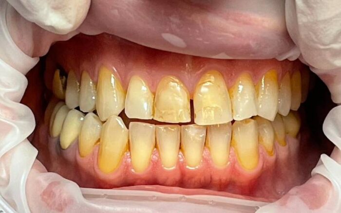 pulizia denti gialli studio porro artusa