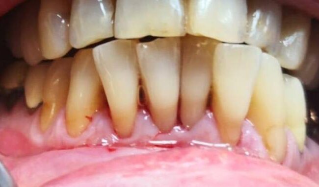 sbiancamento dentale denti gialli sbiancamento dentale denti gialli