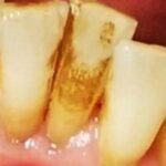 sbiancamento denti cover