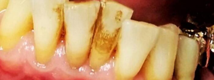 sbiancamento denti cover