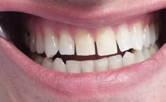 sbiancamento denti professionale studio porro artusa sbiancamento denti professionale studio porro artusa