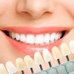 faccette dentali ceramica