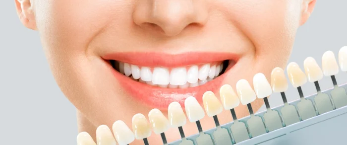 faccette dentali ceramica