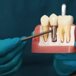 IMPLANTOLOGIA DIABETE