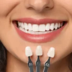 feccette estetiche dentali