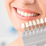 Faccette ceramiche per i denti